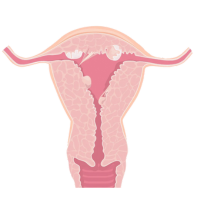 Ablación endometrial Ablación endometrial en SLP