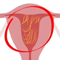 Adherencias Histeroscopia Diagnóstica en San Luis Potosí