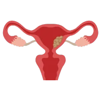 Pólipos Endometriales Histeroscopia Diagnóstica en San Luis Potosí