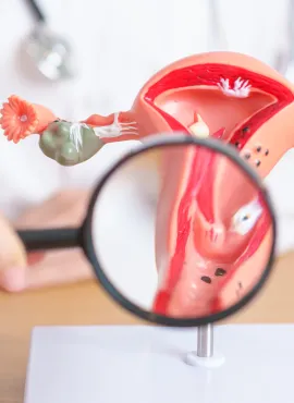 Qué pasa cuando una mujer tiene miomas Cirugía de Miomas en San Luis Potosí