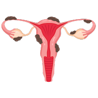 Tratamiento de la endometriosis Tratamiento de la endometriosis en san luis potosi