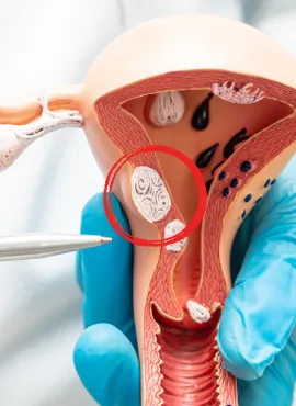 mejores ginecologos operacion de miomas en san luis potosí